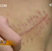 kidney-ipad-scar kidney-ipad-scar