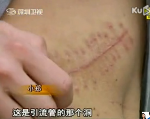 China Charges 5 People in Kidney-for-iPad Affair