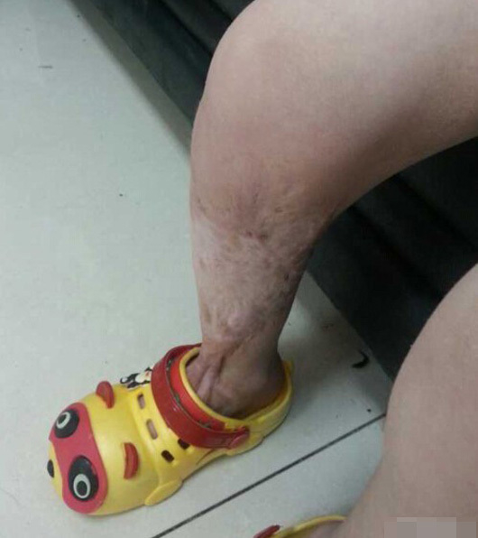 Game-addicted Chinese mom burns, abandons daughter Game-addicted Chinese mom burns, abandons daughter